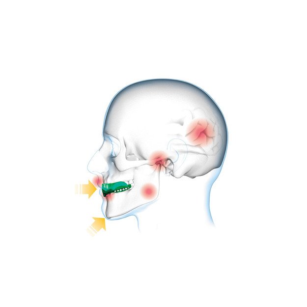 Protège-dents Shock Doctor Gel Max Power Carbon Trans Bleu