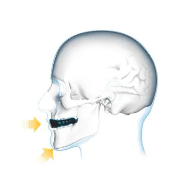 Protège-dents Shock Doctor Gel Max Transparent - 2