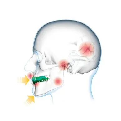 Protège-dents Shock Doctor Gel Max Power Carbon Trans Bleu - 3